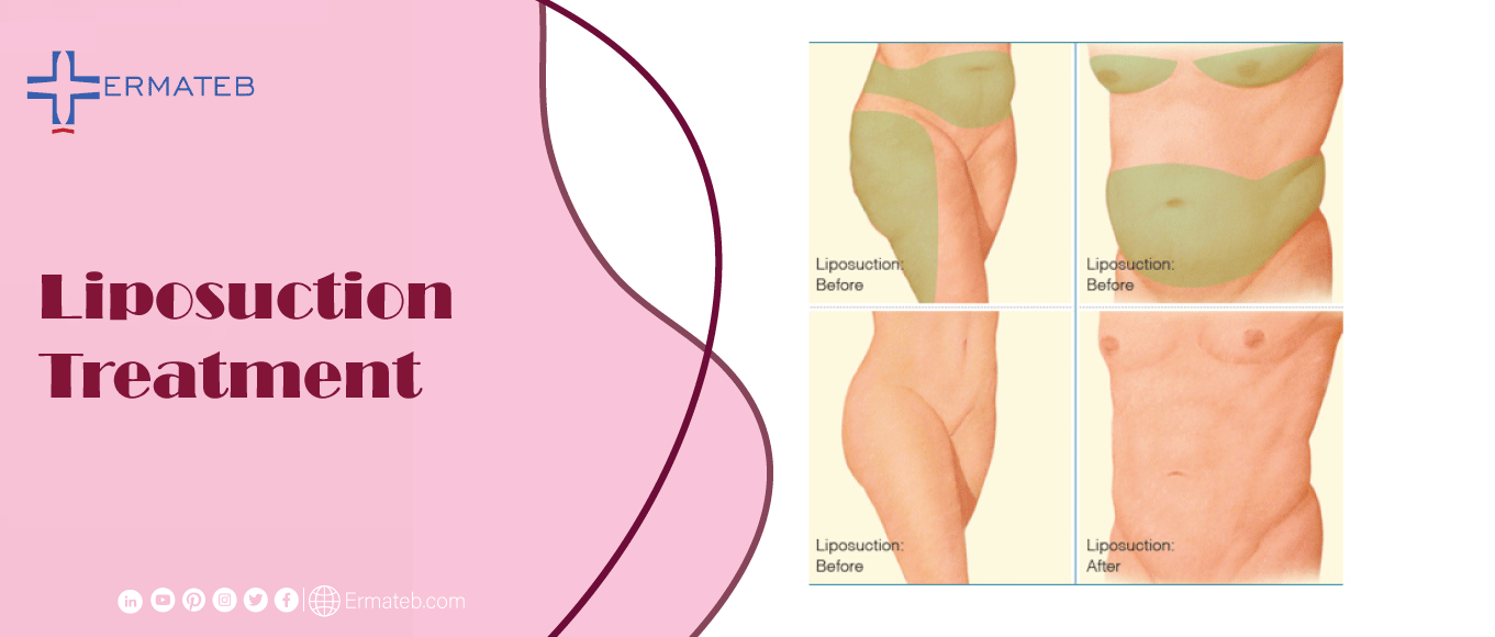 body liposuction